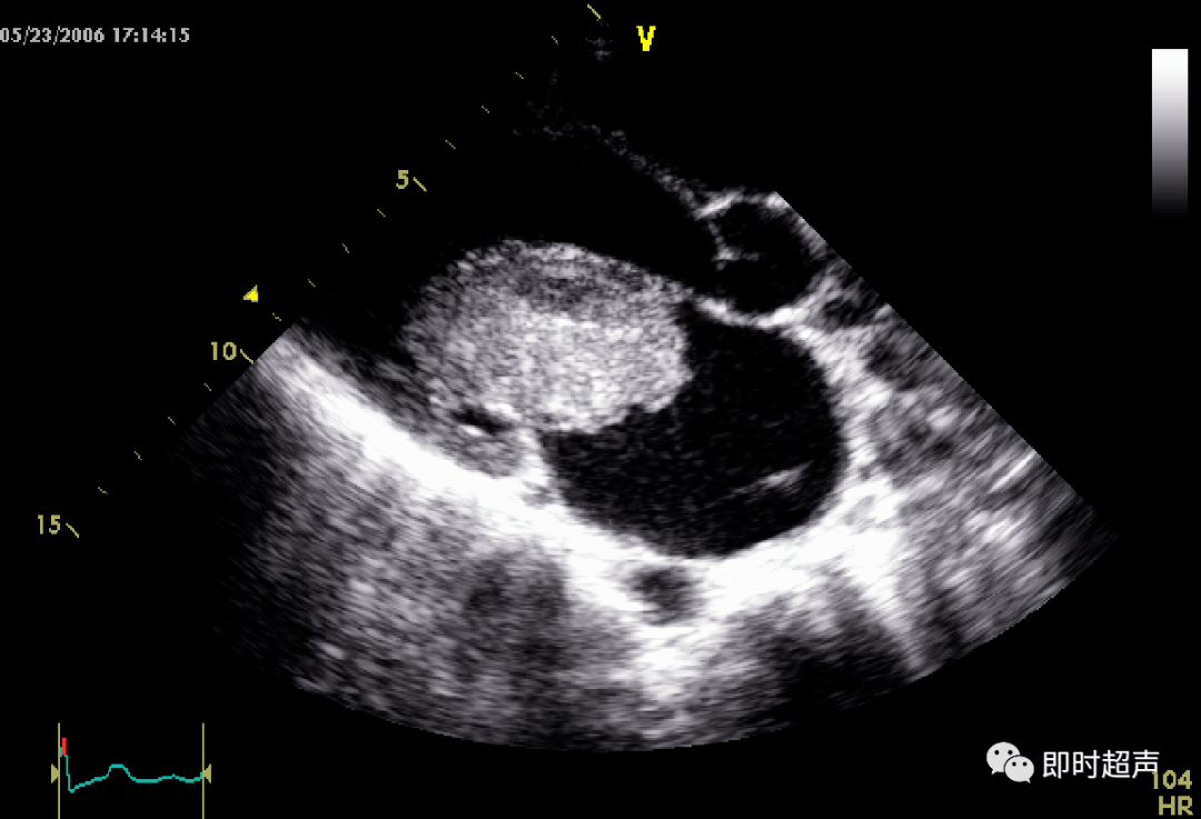 心脏瓣膜病超声诊断_二尖瓣