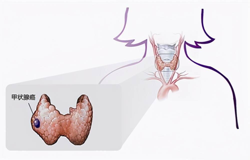 带你认识甲状腺癌四大类