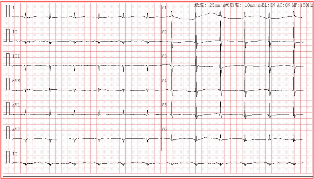 有关 右束支阻滞 的4 问4 答 附典型心电图 基础篇 右室
