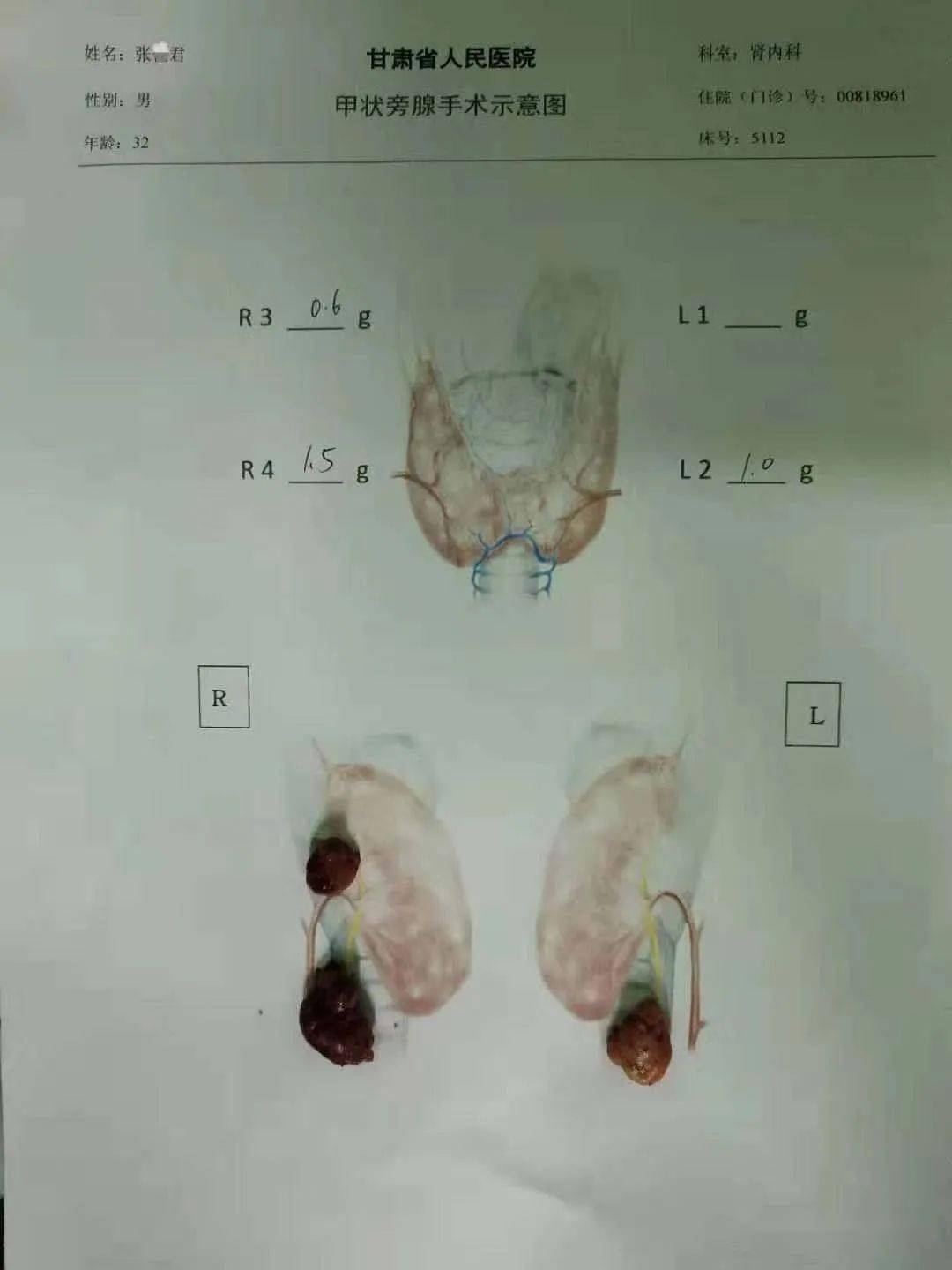 透析患者肾移植前合并继发性甲状旁腺功能亢进症shpt的处理