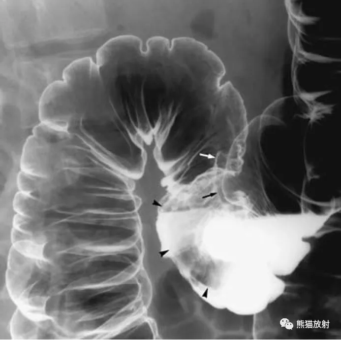 腹部影像图例结直肠篇