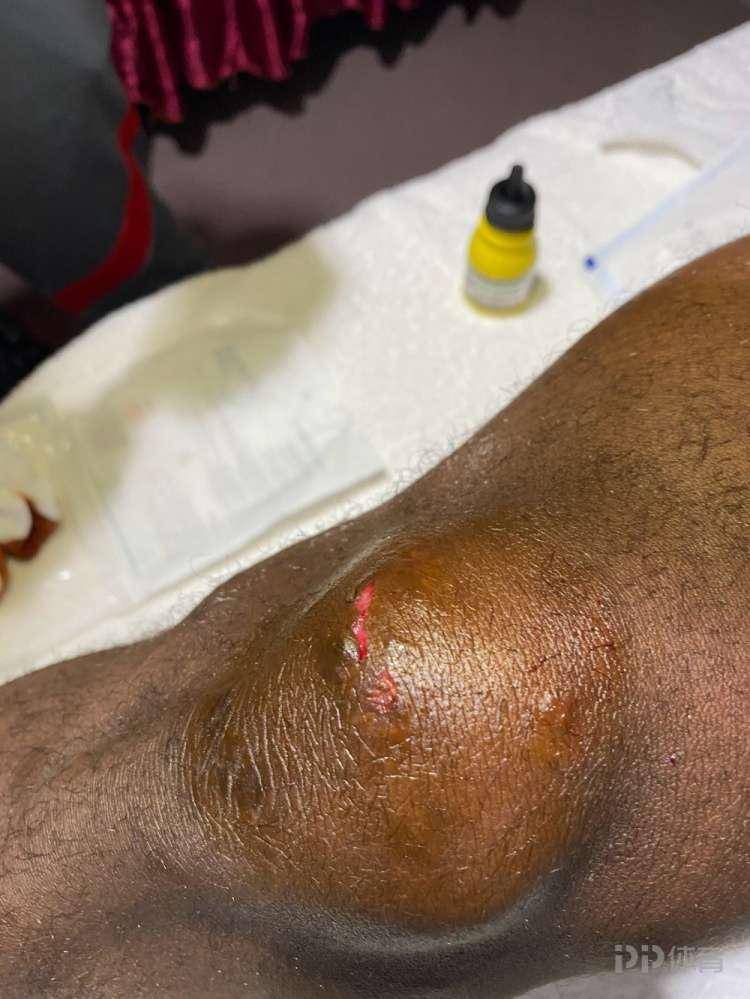 申花新闻官晒巴索戈受伤部位:膝盖肿胀明显 正面被开口子