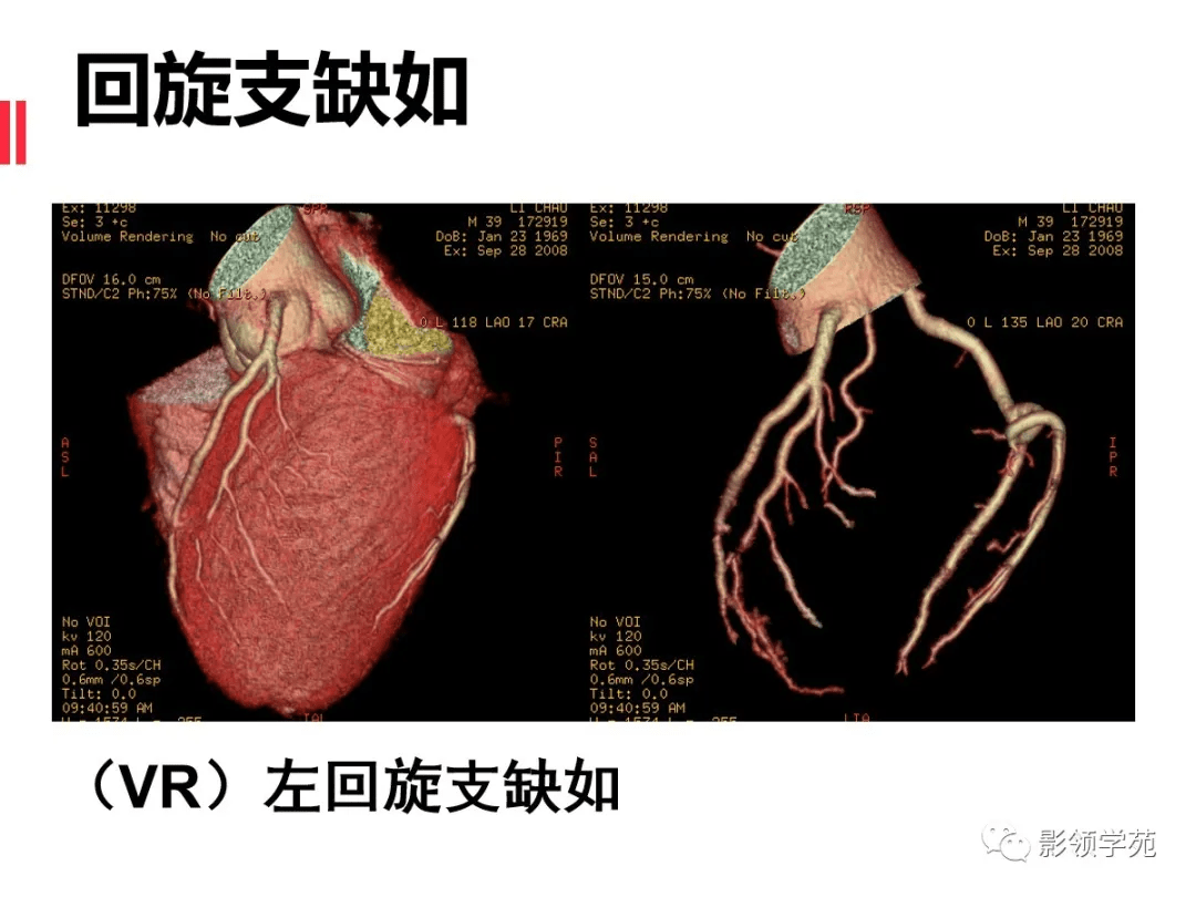 如何分析冠状动脉cta_平台