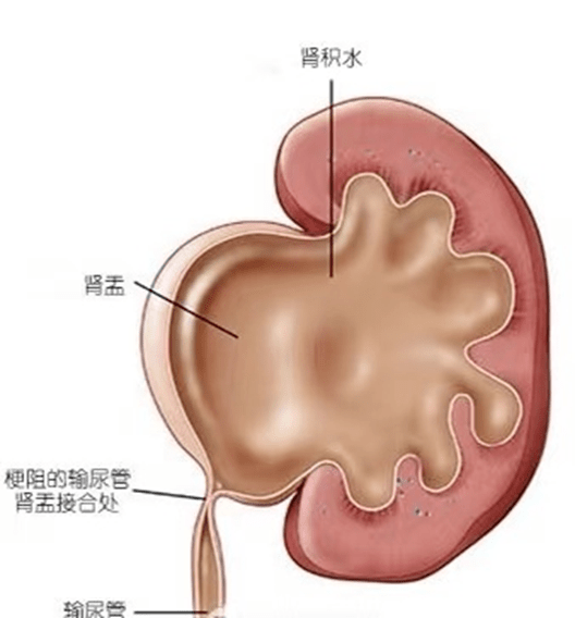 3岁女童腹痛病因竟是它肾积水妇儿医院微创手术解难题