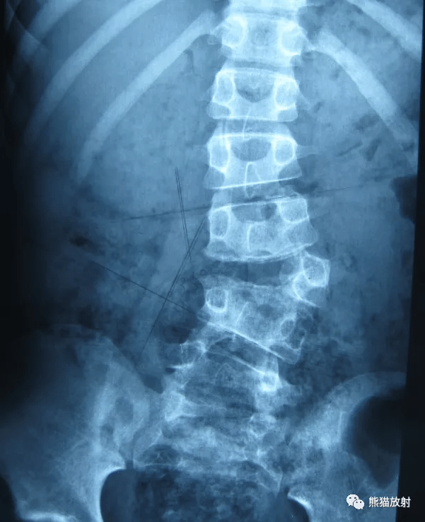 隐性脊柱裂x线图片图片