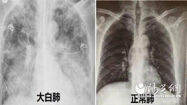 宝鸡市中医医院icu Ricu成功救治0斤 大白肺 患者 罗大爷