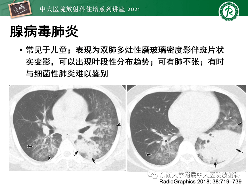 【中大放射住培系列讲座】常见细菌性肺炎与病毒性肺炎的鉴别诊断