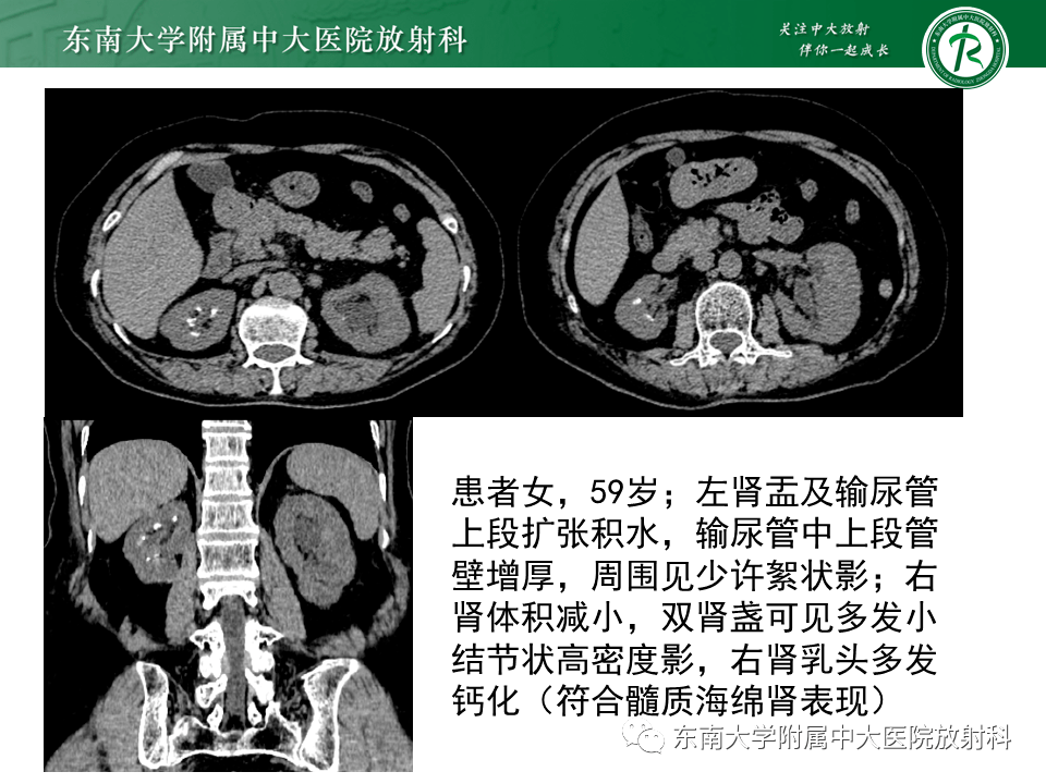 05.14 泌尿系统疾病——肾结核