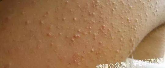 整个脸上都是鸡皮肤怎么办(整个脸上都是鸡皮肤怎么办呢)