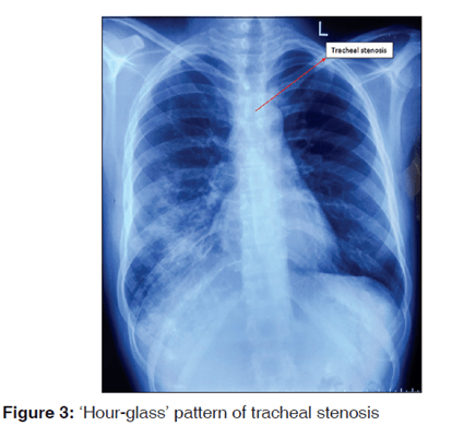 醉译献气道的放射学评估麻醉医师需要知道什么