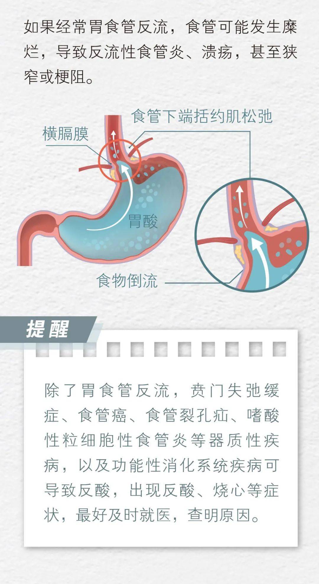 烧心是什么原理_烧心吃什么药