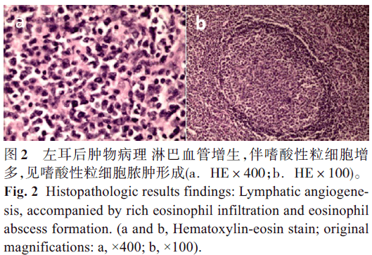 雙側耳後嗜酸性淋巴肉芽腫1例