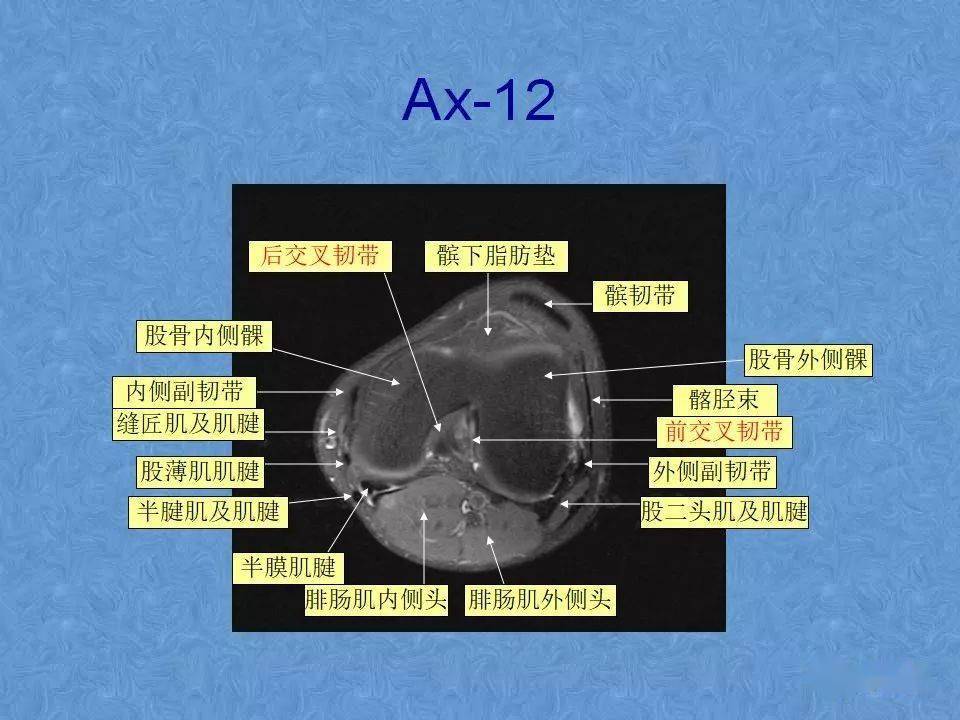 70張膝關節mri高清解剖圖解推薦收藏