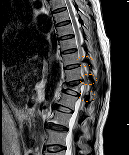 胸9-腰1嚴重黃韌帶骨化,胸椎骨狹窄,明顯壓迫脊髓;胸12骨折,胸腰段