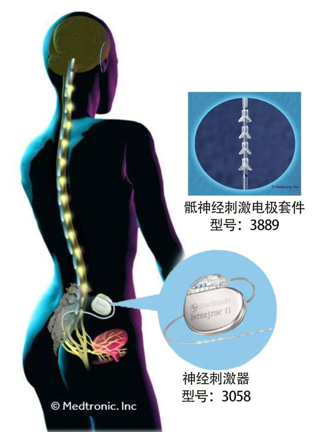 骶神经刺激器图片