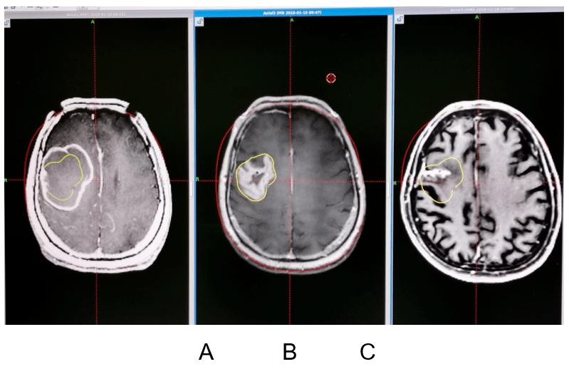 研究孙君昭张剑宁立体定向ommaya囊植入联合伽玛刀治疗颅内大型囊性