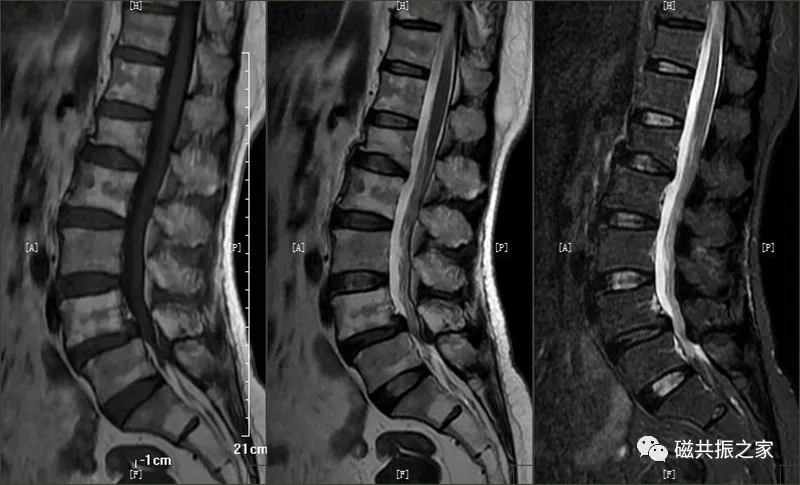 松质骨的表现为椎体内局限性的短t1,长t2信号,病灶边界清楚,脂肪抑制