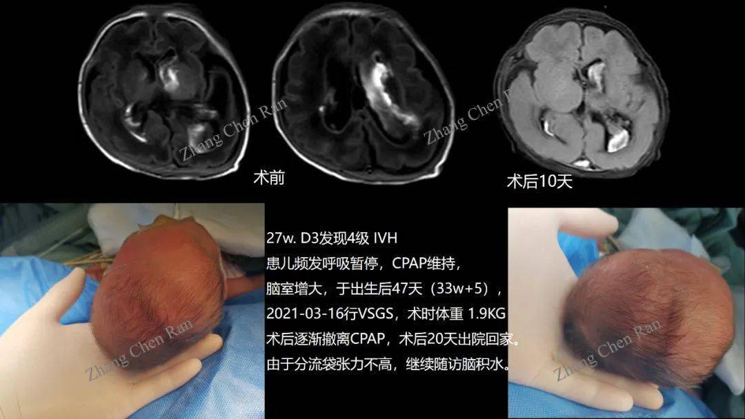 病例分享脑室帽状腱膜下分流术在脑室内出血后脑积水中的应用心得分享