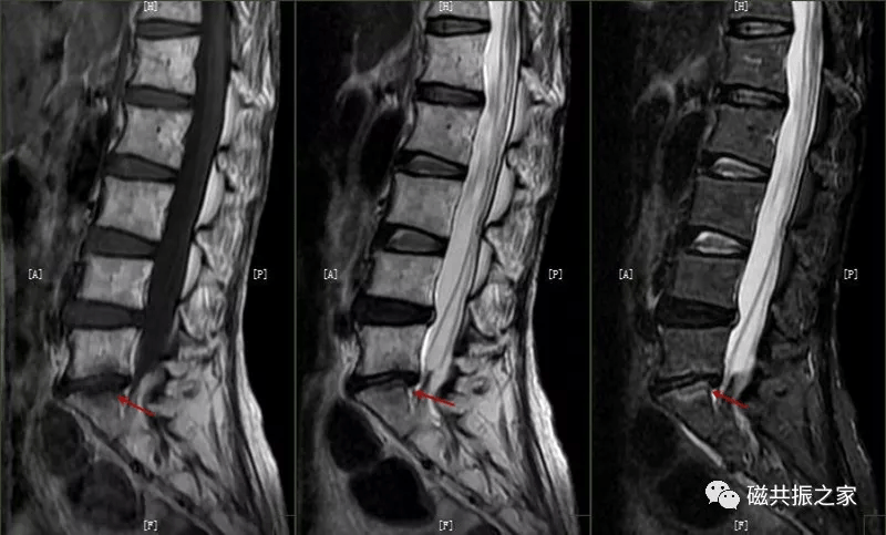 椎体终板呈椭圆形,由骨性终板(0.5mm)和软骨终板(0.5mm)共同构成.