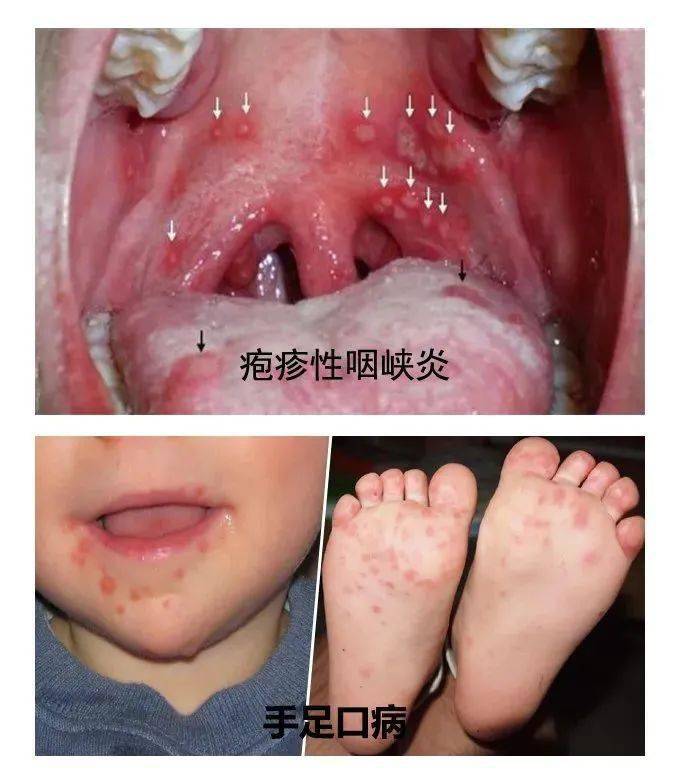 轻症的手足口病主要表现是手,脚,嘴巴里长红色丘疹