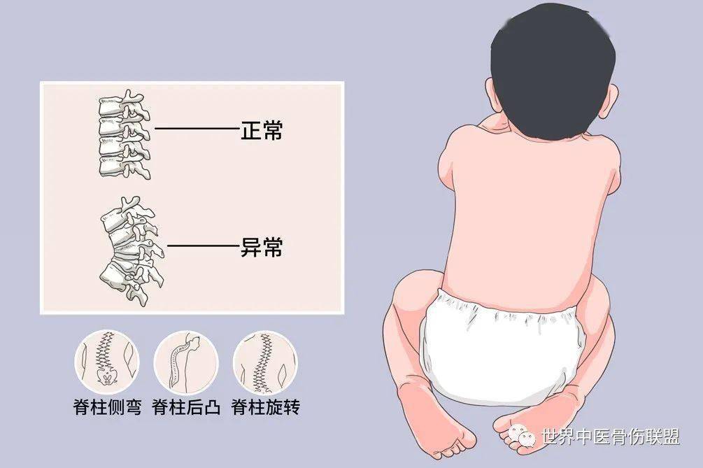 先天性椎体畸形