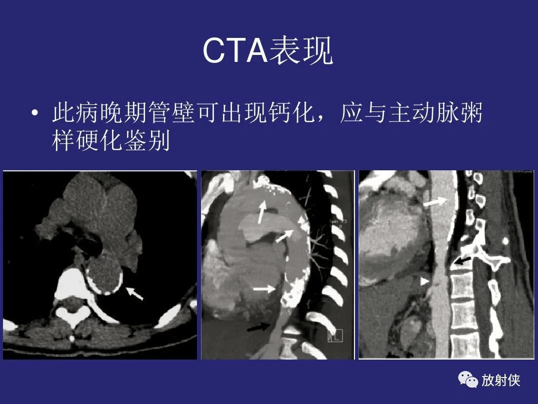 精品大动脉炎分型及ct诊断