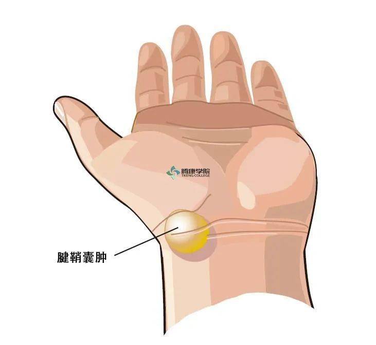 手腕腱鞘囊肿解剖图图片