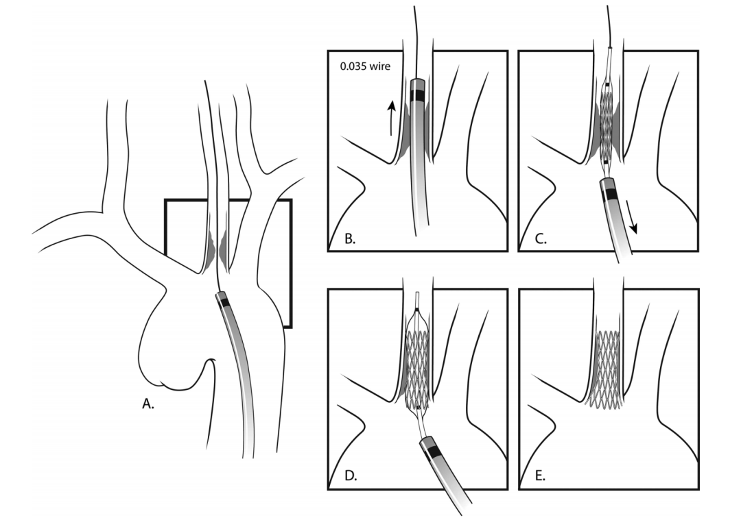 宣武crc星期五丨一表说明颈总动脉近端狭窄的病因