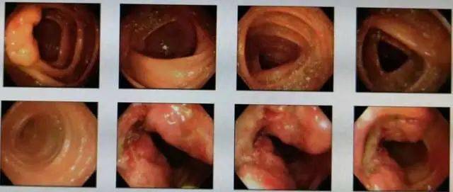 6种症状需做肠镜检查图片