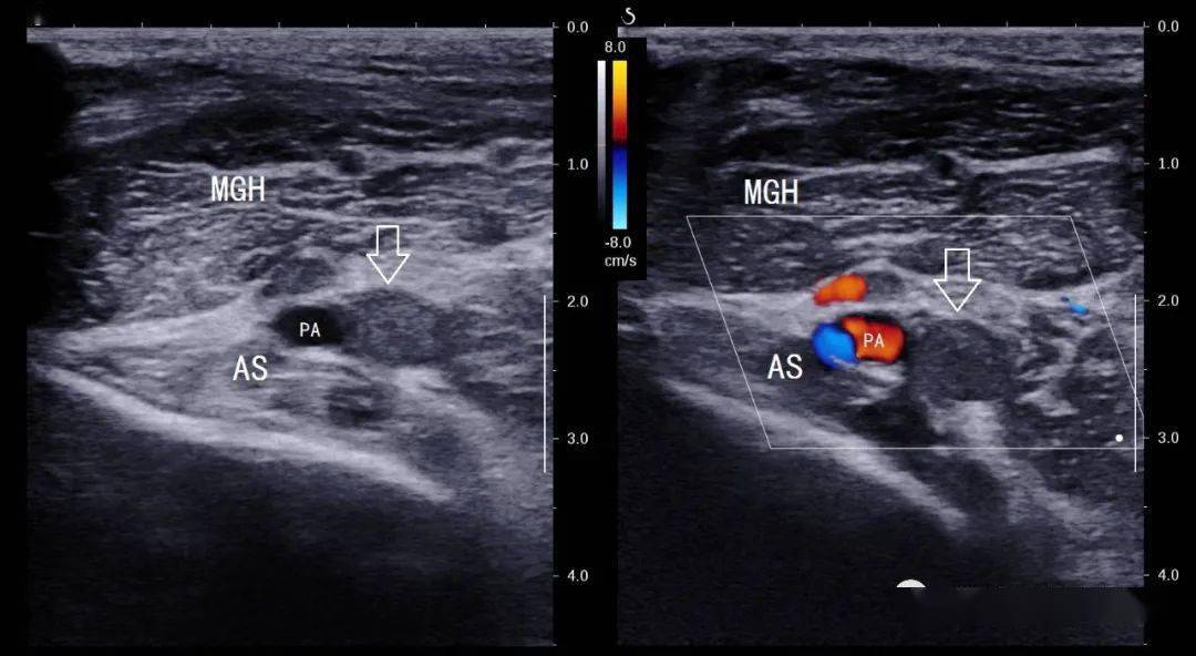 典型病例61腘动脉陷迫综合征