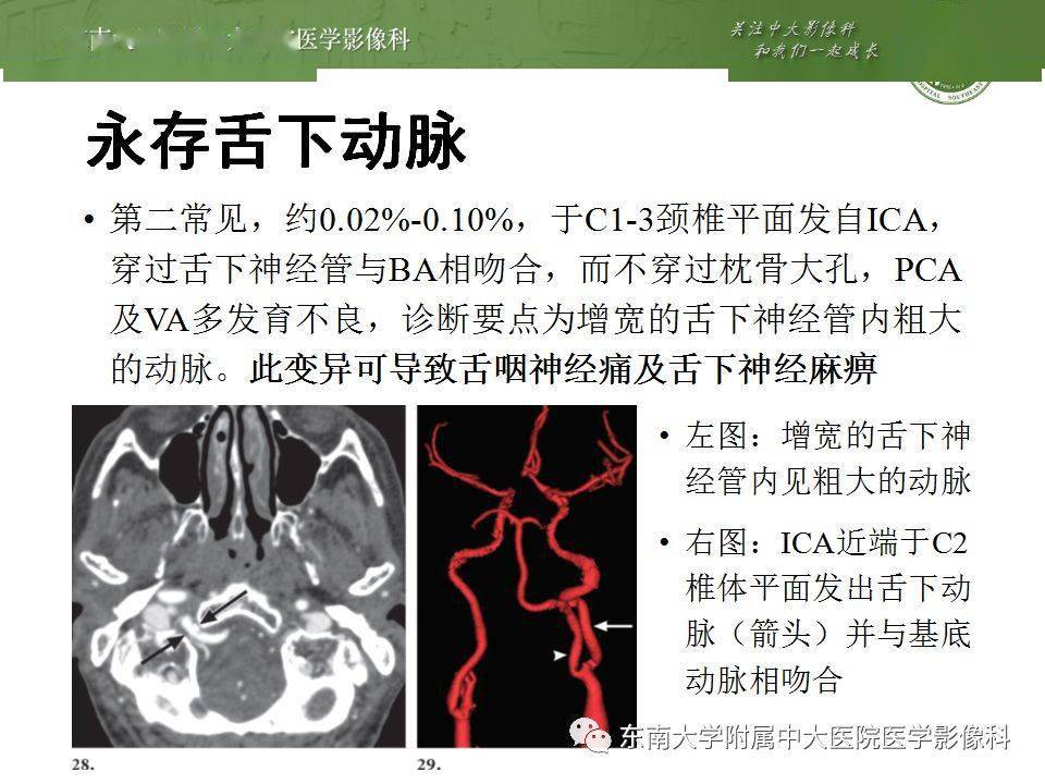 病例结果:永存三叉动脉编辑/校对:郑孝飞ct女,63岁,因"头晕20天"入院