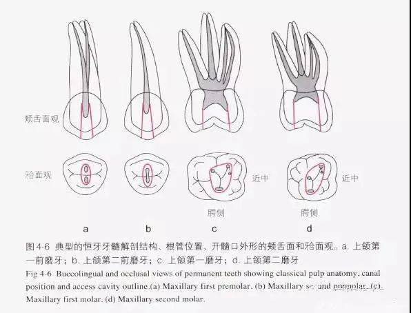 上颌6开髓口形状图片