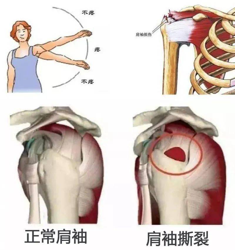 肱骨疼是什么原因图片