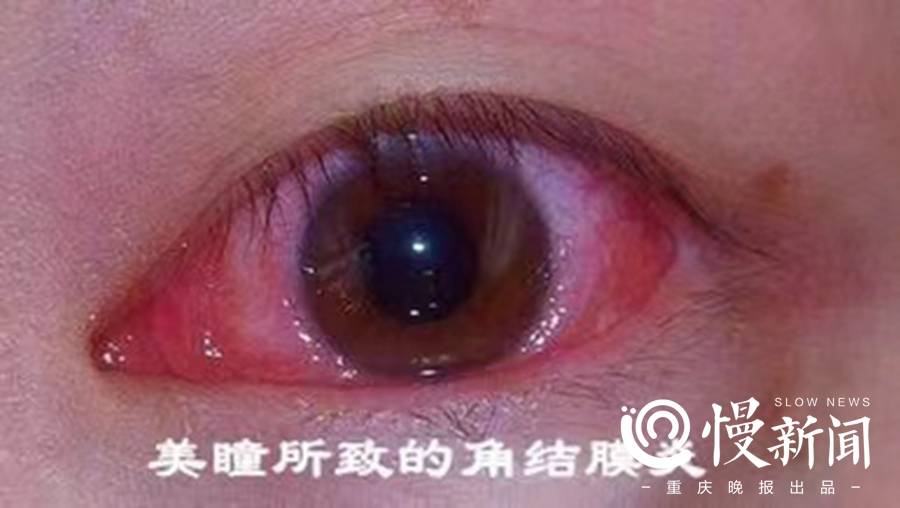 美瞳导致的结膜炎不仅是纹眼线,市面上常见的美瞳也带来了一定的"变