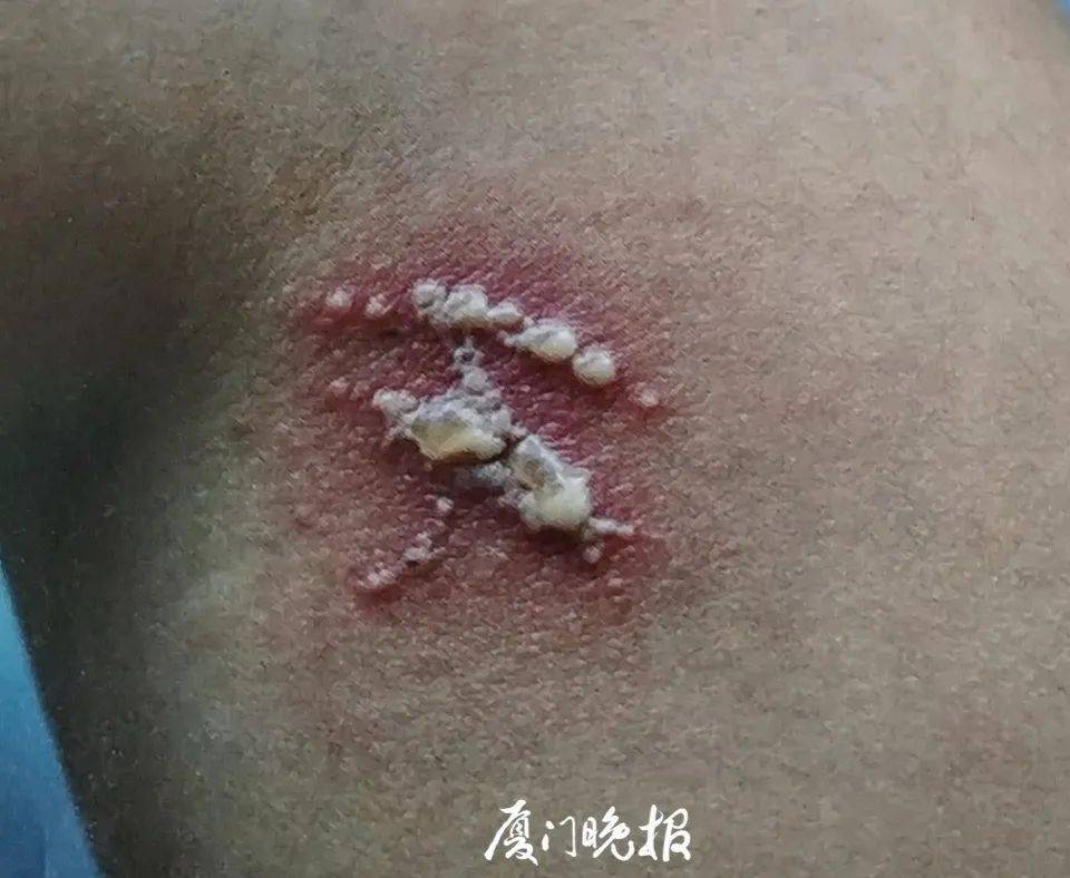 当皮肤接触到隐翅虫毒液时,可用肥皂水紧急冲洗,随后到医院检查治疗.