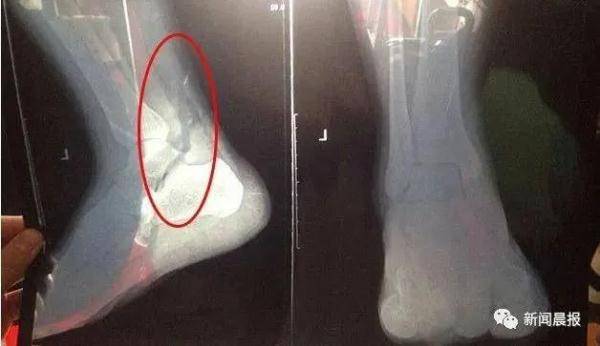 手摔断了多久能好 0d764a9764c740af8fa5de2149684cfe.jpeg