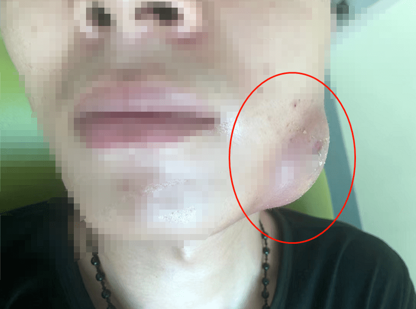 不要因为短暂性的疼痛而对智齿发炎不以为意.