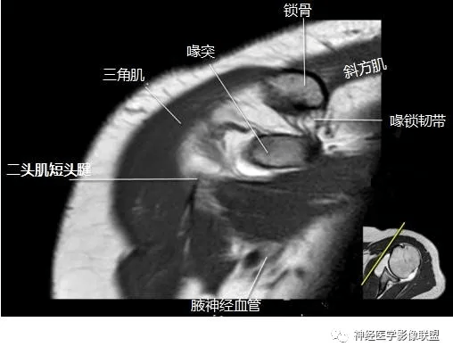 肩关节磁共振断层解剖