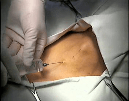 气管切开术的基本操作与重点技巧汇总_手术