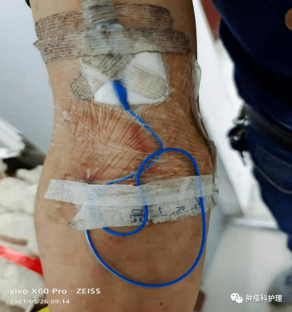 picc导管重度脱出该如何处理?