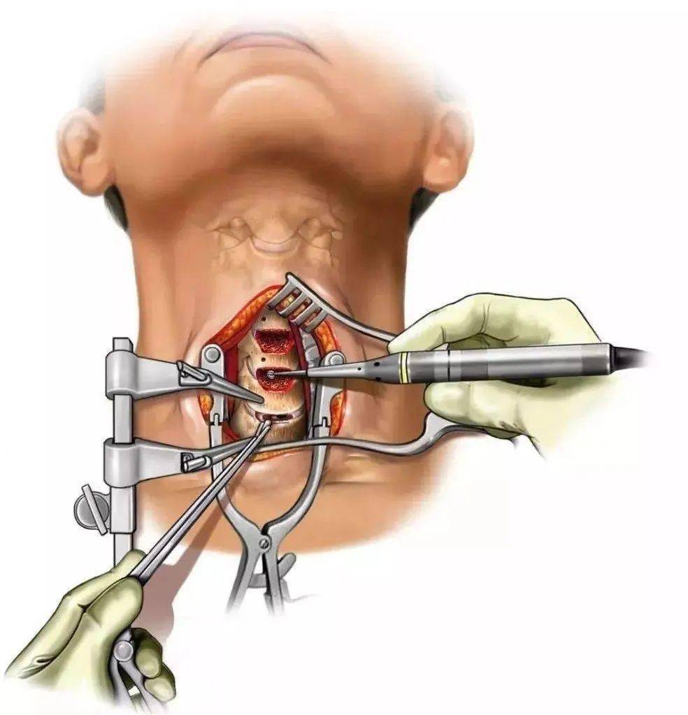 颈椎星状神经节阻滞术图片