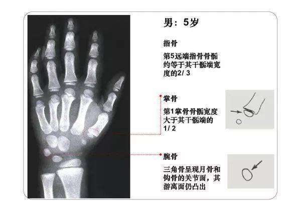 骨骺板图片