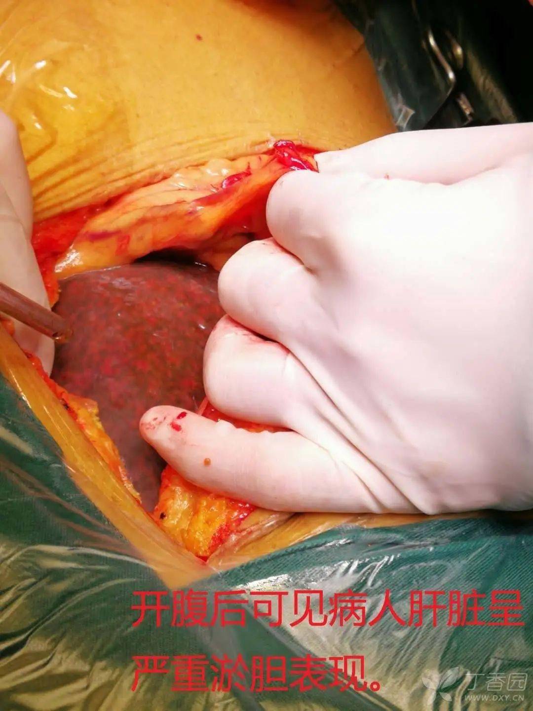 术中从患者肝内竟掏出了「粉皮」和「葡萄」,怎么回事?_tbil