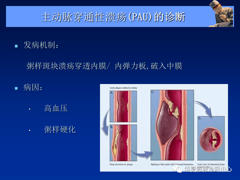 冠状动脉夹层破裂视频_冠状动脉夹层破裂视频_冠状动脉夹层破裂视频