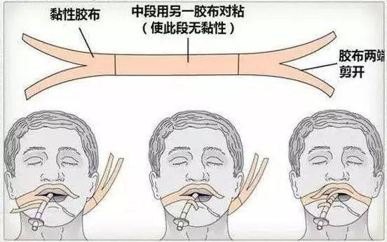 气管插管固定工字图片