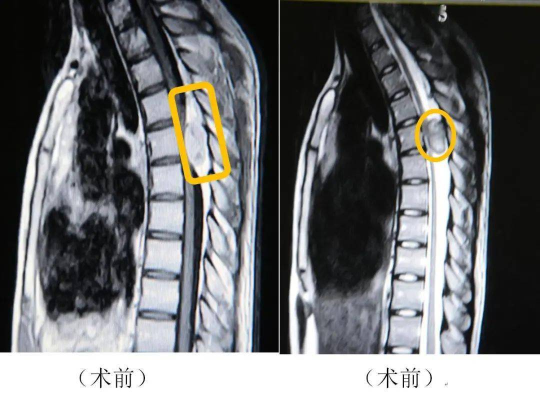 椎管内脊膜瘤03术后复查颅脑mri见肿瘤全切,原肿瘤位置见液性暗区.