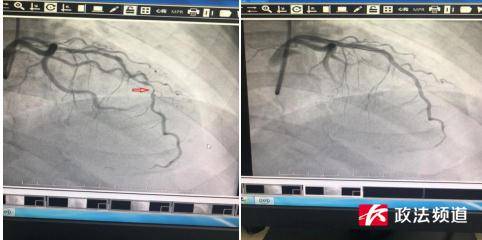 老人|长沙6旬老人反复牙痛，入院检查竟与心脏有关