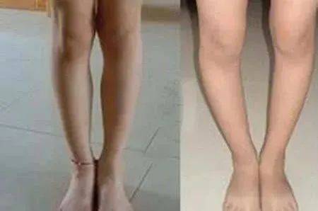 影响|跷二郎腿，是你身体的“慢性毒药”