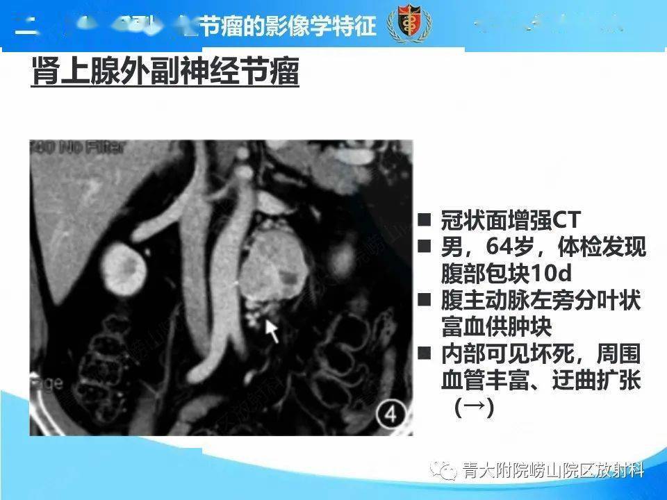 腹膜后副神经节瘤的影像学诊断与鉴别诊断