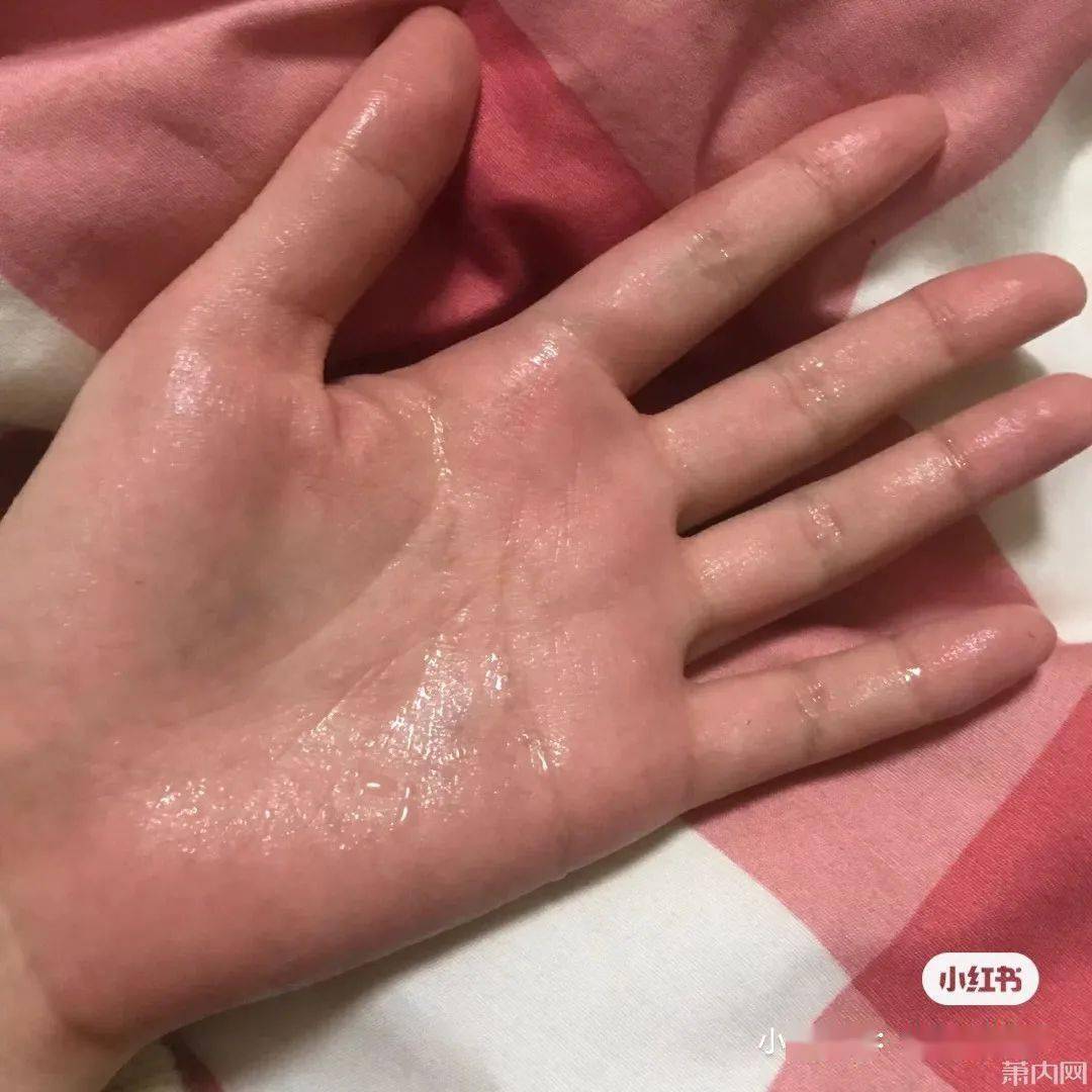 交感神经|萧山姑娘这个尴尬多年的病症，终于下决心做了手术！经历值得一看